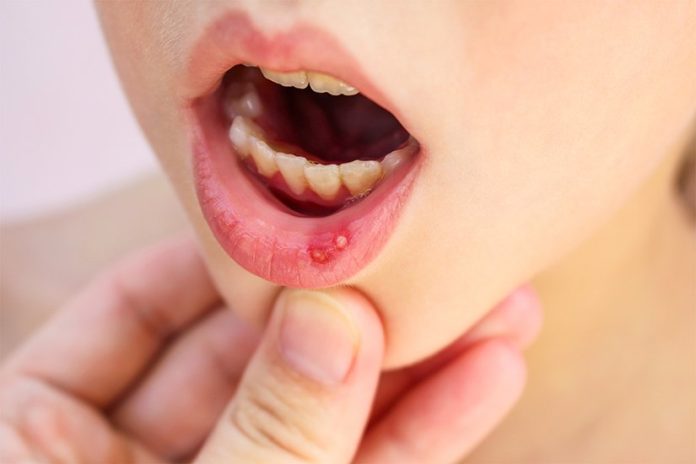 home remedies to cure mouth ulcers naturally
