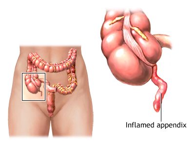 what is the cause of appendicitis